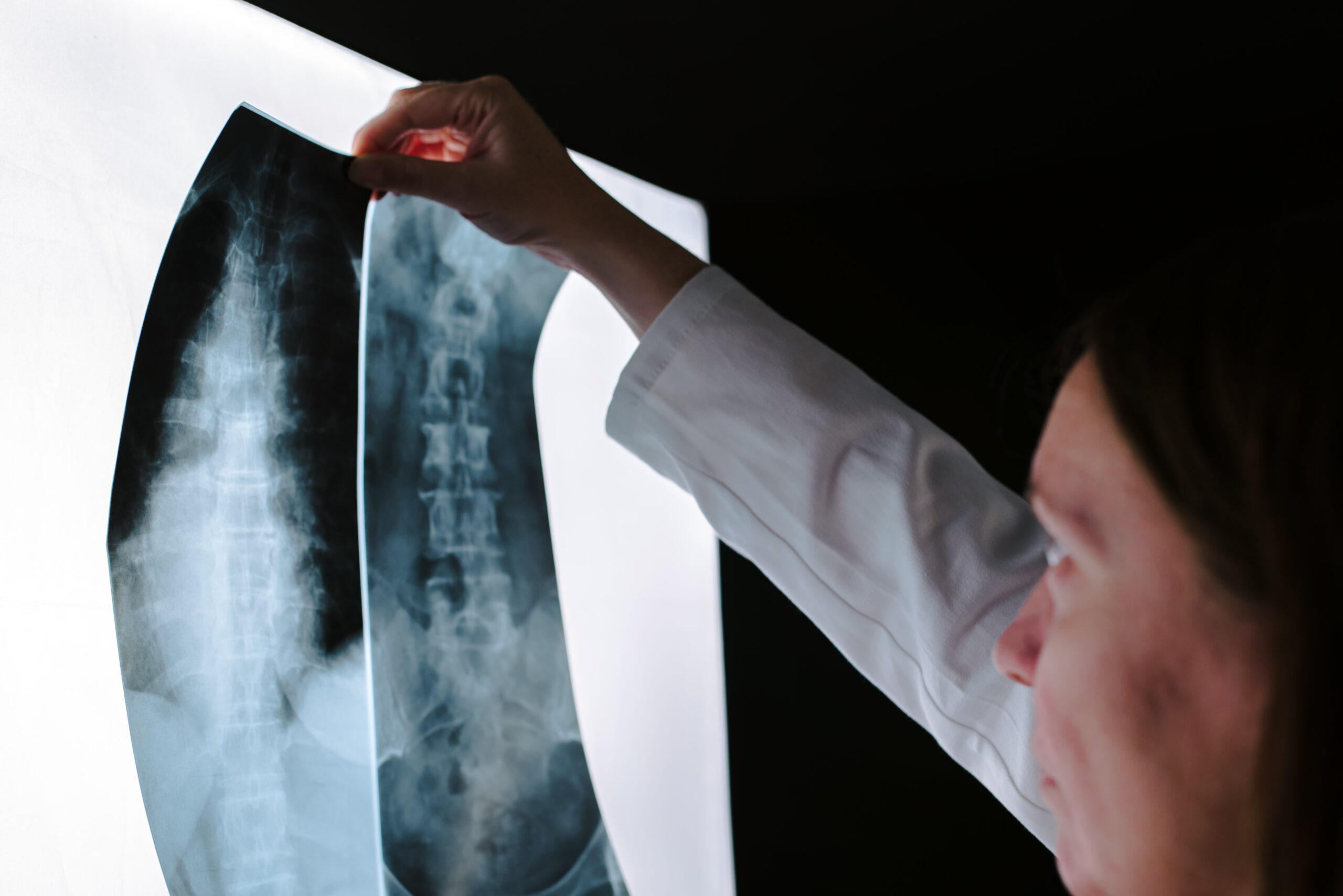 spinal cord damage